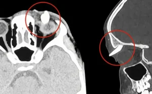16 yaşlı yeniyetmənin qaşının altında diş çıxdı - Dünyada İLK