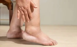 Ayaqların şişməsi bu xəstəliklərin əlaməti ola bilər